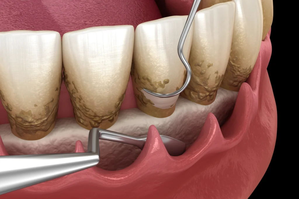 chirurgie assainissement parodontal Soins des gencives Chirurgiens-dentistes à Meulan-en-Yvelines