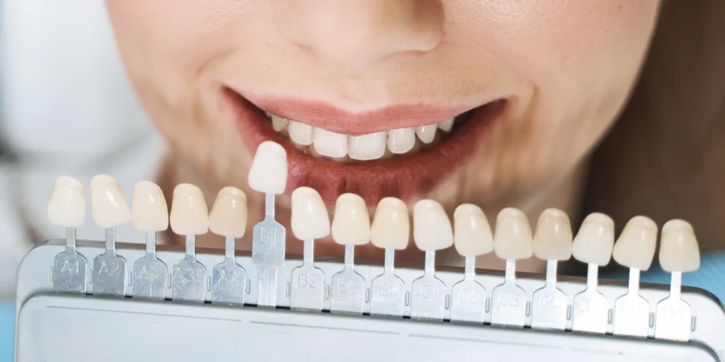 facettes dentaires veneers meulan en yvelines Soins dentaires Chirurgiens-dentistes à Meulan-en-Yvelines