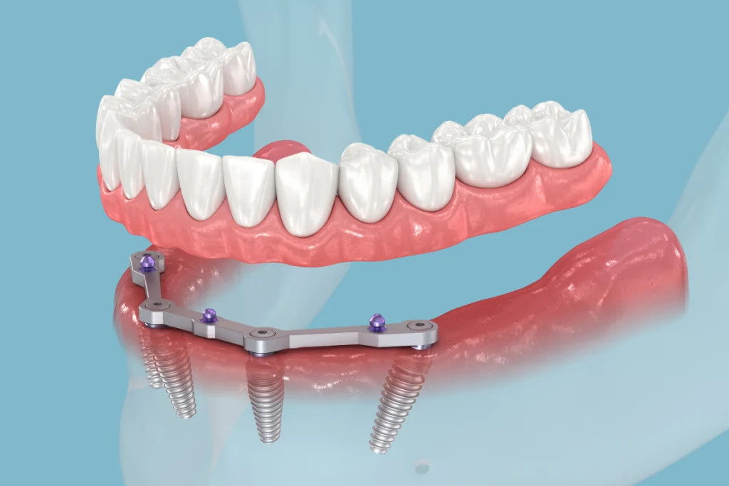 implant complet implant complet Implants dentaires Chirurgiens-dentistes à Meulan-en-Yvelines