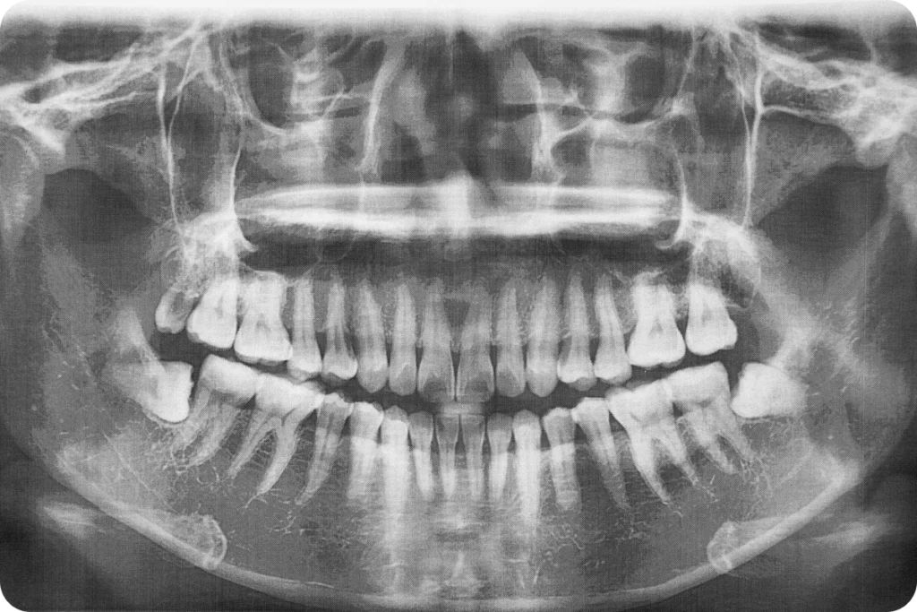 dent sagesse meulan en yvelines Dent de sagesse Chirurgiens-dentistes à Meulan-en-Yvelines