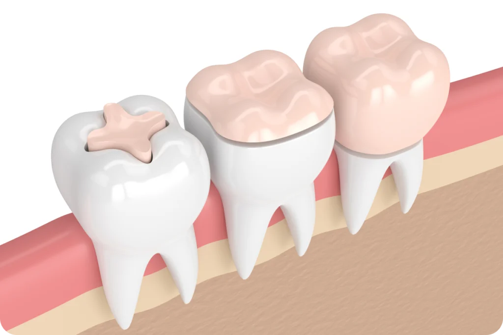 rdv dent casse meulan en yvelines rdv dent casse meulan en yvelines Dent cassée Chirurgiens-dentistes à Meulan-en-Yvelines