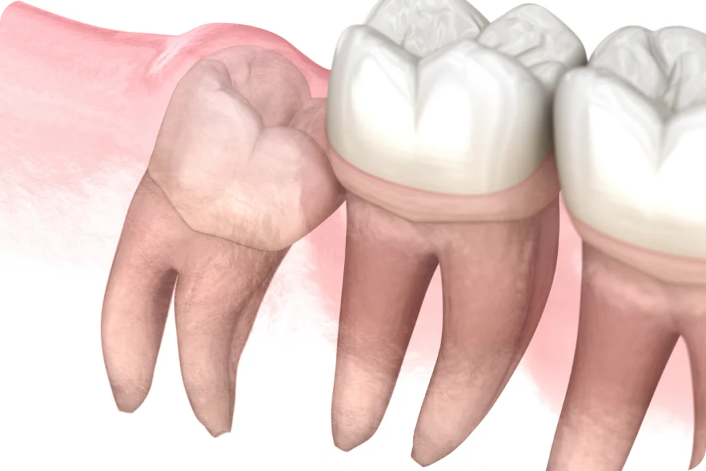 rdv dent sagesse meulan en yvelines Dent de sagesse Chirurgiens-dentistes à Meulan-en-Yvelines