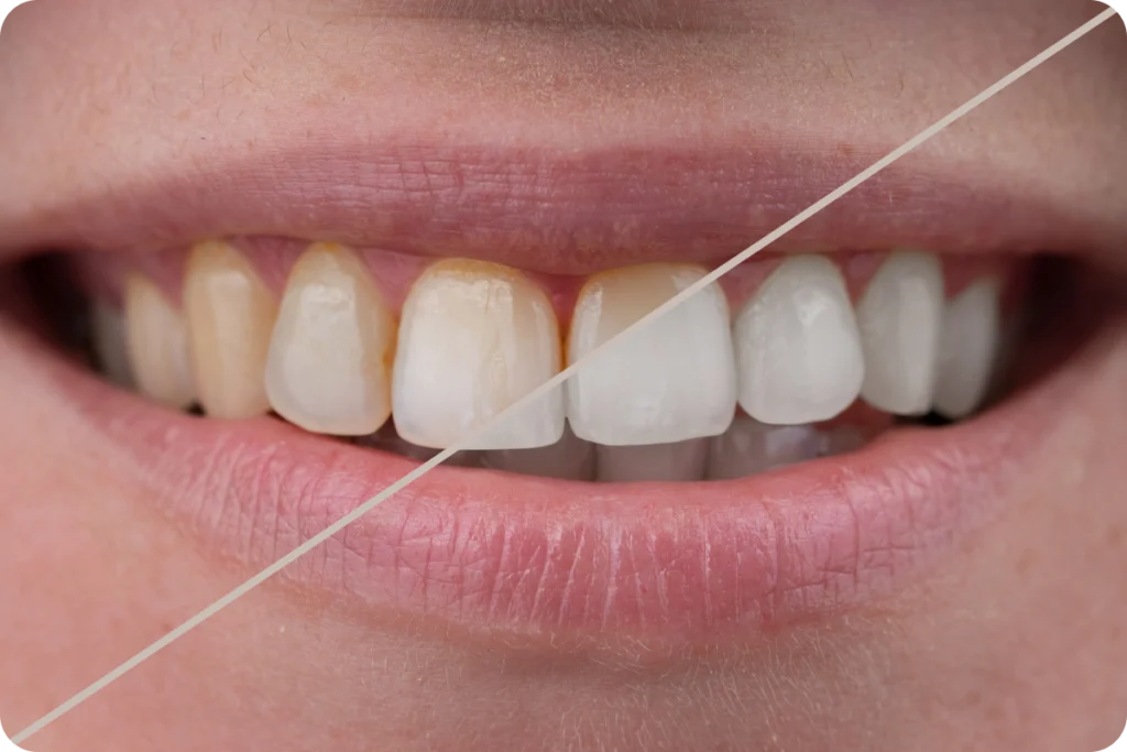 rdv dentiste blanchiment dentaire meulan en yvelines Blanchiment dentaire Chirurgiens-dentistes à Meulan-en-Yvelines