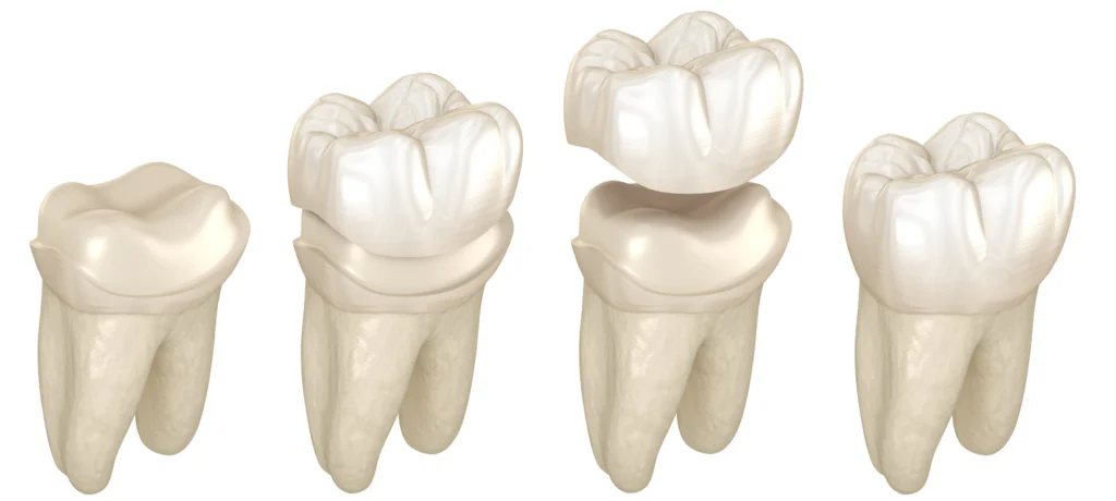 rdv dentiste couronne dentaire meulan en yvelines rdv dentiste couronne dentaire meulan en yvelines Couronne dentaire Chirurgiens-dentistes à Meulan-en-Yvelines